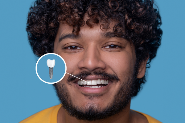 Implantes Dentários