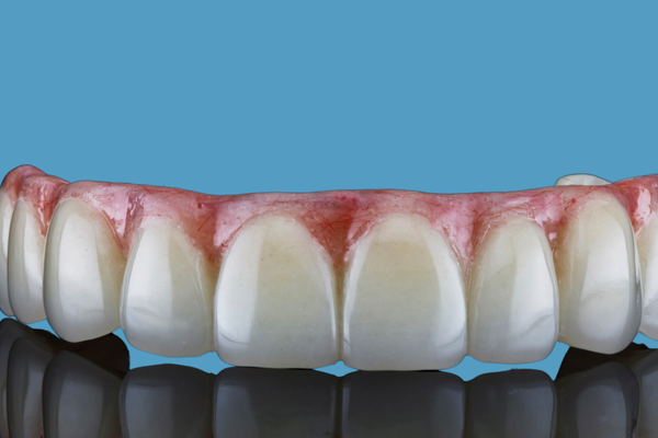 Prótese Dentária
